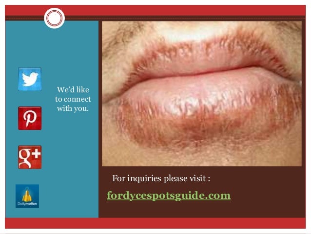 Don recommendet pearly penile papules removal join