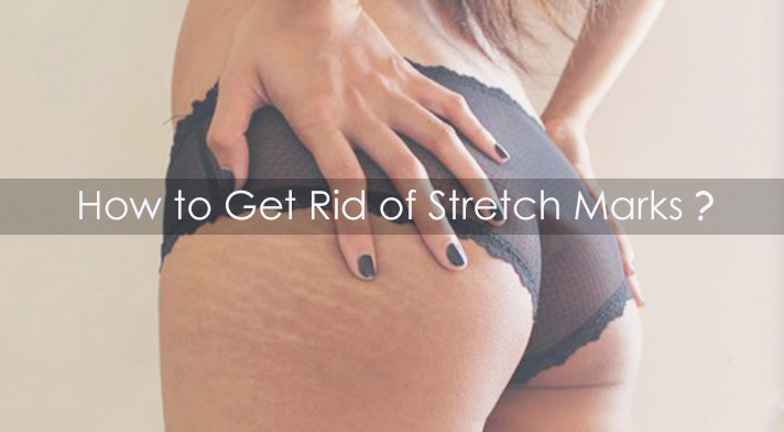 Stretch marks could make