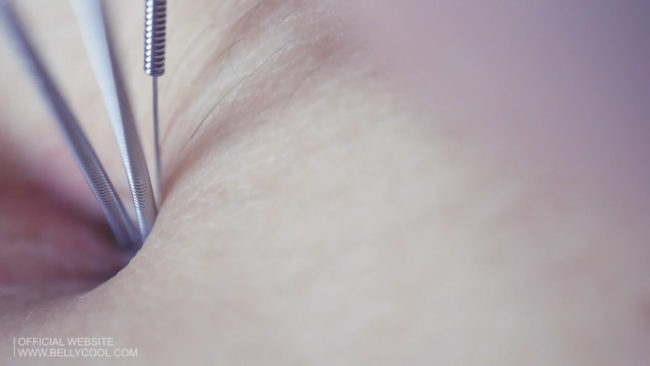 Belly button needle