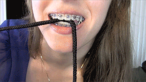 Mudskipper reccomend braces girl wearing elastics