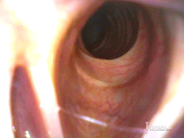 Ace recommend best of vore endoscope